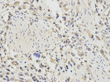TNFAIP3 / A20 Antibody - Immunohistochemistry of paraffin-embedded human stomach cancer using TNFAIP3 antibody at dilution of 1:200 (400x lens).