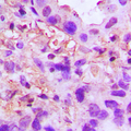 TNFAIP6 / TSG-6 Antibody - Immunohistochemical analysis of TSG6 staining in human lung cancer formalin fixed paraffin embedded tissue section. The section was pre-treated using heat mediated antigen retrieval with sodium citrate buffer (pH 6.0). The section was then incubated with the antibody at room temperature and detected using an HRP conjugated compact polymer system. DAB was used as the chromogen. The section was then counterstained with hematoxylin and mounted with DPX.