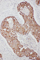 TNFAIP8L3 Antibody - TNFAIP8L3 antibody. IHC(P): Human Breast Cancer Tissue.