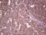 TNFRSF18 / GITR Antibody - IHC of paraffin-embedded Human lymphoma tissue using anti-TNFRSF18 mouse monoclonal antibody. (heat-induced epitope retrieval by 1 mM EDTA in 10mM Tris, pH8.5, 120°C for 3min).