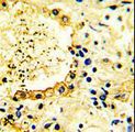 TNK2 / ACK1 Antibody - Formalin-fixed and paraffin-embedded human Lung carcinoma reacted with ACK1 Antibody , which was peroxidase-conjugated to the secondary antibody, followed by DAB staining. This data demonstrates the use of this antibody for immunohistochemistry; clinical relevance has not been evaluated.