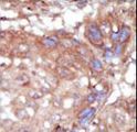 TNK2 / ACK1 Antibody - Formalin-fixed and paraffin-embedded human cancer tissue reacted with the primary antibody, which was peroxidase-conjugated to the secondary antibody, followed by AEC staining. This data demonstrates the use of this antibody for immunohistochemistry; clinical relevance has not been evaluated. BC = breast carcinoma; HC = hepatocarcinoma.