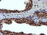 TOMM34 Antibody - IHC of paraffin-embedded Carcinoma of Human prostate tissue using anti-TOMM34 mouse monoclonal antibody.