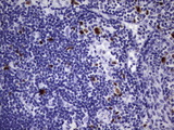 TOP2A / Topoisomerase II Alpha Antibody - Immunohistochemical staining of paraffin-embedded Human lymphoma tissue using anti-TOP2A mouse monoclonal antibody.  heat-induced epitope retrieval by 1 mM EDTA in 10mM Tris, pH9.0, 120C for 3min)