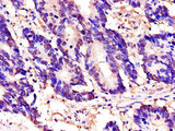 TOR1A / Torsin A Antibody - Immunohistochemistry of paraffin-embedded human colon cancer using TOR1A Antibody at dilution of 1:100