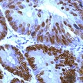 TP53 / p53 Antibody - Colon carcinoma stained with anti-p53 antibody