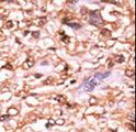 TP53 / p53 Antibody - Formalin-fixed and paraffin-embedded human cancer tissue reacted with the primary antibody, which was peroxidase-conjugated to the secondary antibody, followed by AEC staining. This data demonstrates the use of this antibody for immunohistochemistry; clinical relevance has not been evaluated. BC = breast carcinoma; HC = hepatocarcinoma.