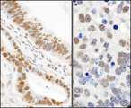 TP53BP1 / 53BP1 Antibody - Detection of Human and Mouse Phospho 53BP1 (S25) by Immunohistochemistry. Sample: FFPE sections of human stomach carcinoma (left) and mouse teratoma (right). Antibody: Affinity purified rabbit anti- Phospho 53bp1 (S25) used at a dilution of 1:1000 (1 ug/ml). Detection: DAB.