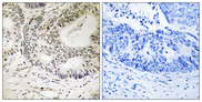 TP53BP1 / 53BP1 Antibody - Immunohistochemistry analysis of paraffin-embedded human colon carcinoma, using 53BP1 (Phospho-Ser25) Antibody. The picture on the right is blocked with the phospho peptide.