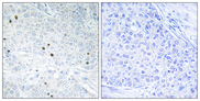 TP53INP2 Antibody - Immunohistochemistry analysis of paraffin-embedded human breast carcinoma tissue, using TP53INP2 Antibody. The picture on the right is blocked with the synthesized peptide.