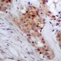 TP53INP2 Antibody - Immunohistochemical analysis of TP53INP2 staining in human breast cancer formalin fixed paraffin embedded tissue section. The section was pre-treated using heat mediated antigen retrieval with sodium citrate buffer (pH 6.0). The section was then incubated with the antibody at room temperature and detected using an HRP polymer system. DAB was used as the chromogen. The section was then counterstained with hematoxylin and mounted with DPX.