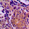 TP63 / p63 Antibody - Immunohistochemical analysis of p63 staining in human breast cancer formalin fixed paraffin embedded tissue section. The section was pre-treated using heat mediated antigen retrieval with sodium citrate buffer (pH 6.0). The section was then incubated with the antibody at room temperature and detected using an HRP conjugated compact polymer system. DAB was used as the chromogen. The section was then counterstained with hematoxylin and mounted with DPX.