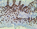 TP63 / p63 Antibody - IHC of p63 on an FFPE Basal Cell Carcinoma Tissue