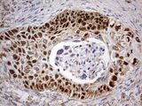 TP63 / p63 Antibody - IHC of paraffin-embedded Carcinoma of Human lung tissue using anti-TP63 mouse monoclonal antibody. (Heat-induced epitope retrieval by 1 mM EDTA in 10mM Tris, pH9.0, 120°C for 3min).