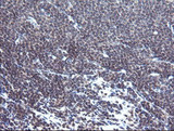 TPD52L3 Antibody - IHC of paraffin-embedded Human lymphoma tissue using anti-TPD52L3 mouse monoclonal antibody. (Heat-induced epitope retrieval by 10mM citric buffer, pH6.0, 120°C for 3min).