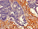 TPH2 Antibody - Immunohistochemistry of paraffin-embedded human colon cancer using TPH2 Antibody at dilution of 1:100