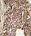 TPI1 / TPI Antibody - Formalin-fixed and paraffin-embedded human prostate carcinoma reacted with TPI1 Antibody , which was peroxidase-conjugated to the secondary antibody, followed by DAB staining. This data demonstrates the use of this antibody for immunohistochemistry; clinical relevance has not been evaluated.