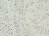 TPPP2 Antibody - Immunohistochemistry of paraffin-embedded human liver cancer using antibody at dilution of 1:100.