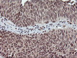 TPSG1 / Tryptase Gamma 1 Antibody - IHC of paraffin-embedded Carcinoma of Human bladder tissue using anti-TPSG1 mouse monoclonal antibody. (Heat-induced epitope retrieval by 10mM citric buffer, pH6.0, 100C for 10min).