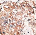 TPX2 Antibody - Formalin-fixed and paraffin-embedded human cancer tissue reacted with the primary antibody, which was peroxidase-conjugated to the secondary antibody, followed by DAB staining. This data demonstrates the use of this antibody for immunohistochemistry; clinical relevance has not been evaluated. BC = breast carcinoma; HC = hepatocarcinoma.