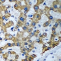 TRAF3IP2 / ACT1 Antibody - Immunohistochemical analysis of ACT1 staining in human liver cancer formalin fixed paraffin embedded tissue section. The section was pre-treated using heat mediated antigen retrieval with sodium citrate buffer (pH 6.0). The section was then incubated with the antibody at room temperature and detected using an HRP conjugated compact polymer system. DAB was used as the chromogen. The section was then counterstained with hematoxylin and mounted with DPX.
