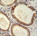TRAM2 Antibody - TRAM2 antibody immunohistochemistry of formalin-fixed and paraffin-embedded human prostate carcinoma followed by peroxidase-conjugated secondary antibody and DAB staining.