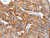 TRAP1 / HSP75 Antibody - Immunohistochemistry of paraffin-embedded Human esophagus cancer using TRAP1 Polyclonal Antibody at dilution of 1:100.
