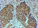 TRIM24 / TIF1 Antibody - Goat Anti-TIF1A / TRIM24 Antibody (4µg/ml) staining of paraffin embedded Human Breast cancer. Steamed antigen retrieval with citrate buffer pH 6, HRP-staining.