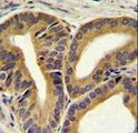 TRIM65 Antibody - TRIM65 Antibody immunohistochemistry of formalin-fixed and paraffin-embedded human prostate carcinoma followed by peroxidase-conjugated secondary antibody and DAB staining.