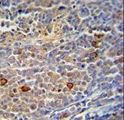 TRMO / C9orf156 Antibody - C9orf156 Antibody immunohistochemistry of formalin-fixed and paraffin-embedded human skin carcinoma followed by peroxidase-conjugated secondary antibody and DAB staining.