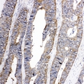 TRPC3 Antibody - TRPC3 antibody. IHC(P): Human Rectal Cancer Tissue.