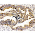 TRPM4 Antibody - TRPM4 was detected in paraffin-embedded sections of human intestinal cancer tissues using rabbit anti- TRPM4 Antigen Affinity purified polyclonal antibody at 1 ug/mL. The immunohistochemical section was developed using SABC method.