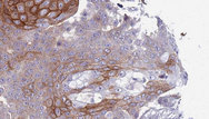 TRPM7 Antibody - 1:100 staining human urothelial carcinoma tissue by IHC-P. The sample was formaldehyde fixed and a heat mediated antigen retrieval step in citrate buffer was performed. The sample was then blocked and incubated with the antibody for 1.5 hours at 22°C. An HRP conjugated goat anti-rabbit antibody was used as the secondary.