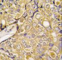 TRPM8 Antibody - Formalin-fixed and paraffin-embedded human prostate carcinoma tissue reacted with TRPM8 antibody (Center R536) , which was peroxidase-conjugated to the secondary antibody, followed by DAB staining. This data demonstrates the use of this antibody for immunohistochemistry; clinical relevance has not been evaluated.