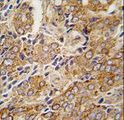 TRPM8 Antibody - Formalin-fixed and paraffin-embedded human prostate carcinoma tissue reacted with TRPM8 antibody (C-term C940) , which was peroxidase-conjugated to the secondary antibody, followed by DAB staining. This data demonstrates the use of this antibody for immunohistochemistry; clinical relevance has not been evaluated.