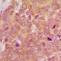TSEN54 Antibody - Immunohistochemical analysis of SEN54 staining in human breast cancer formalin fixed paraffin embedded tissue section. The section was pre-treated using heat mediated antigen retrieval with sodium citrate buffer (pH 6.0). The section was then incubated with the antibody at room temperature and detected with HRP and DAB as chromogen. The section was then counterstained with hematoxylin and mounted with DPX.
