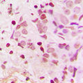 TSHZ1 Antibody - Immunohistochemical analysis of TSHZ1 staining in human breast cancer formalin fixed paraffin embedded tissue section. The section was pre-treated using heat mediated antigen retrieval with sodium citrate buffer (pH 6.0). The section was then incubated with the antibody at room temperature and detected using an HRP-conjugated compact polymer system. DAB was used as the chromogen. The section was then counterstained with hematoxylin and mounted with DPX.