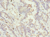 TSSK3 / STK22C Antibody - Immunohistochemistry of paraffin-embedded human lung cancer at dilution 1:100