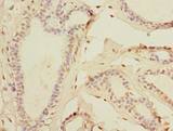 TTC33 Antibody - Immunohistochemistry of paraffin-embedded human breast cancer using antibody at dilution of 1:100.