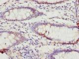 TTC38 Antibody - Immunohistochemistry of paraffin-embedded human colon cancer using antibody at dilution of 1:100.