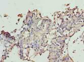 TTC9C Antibody - Immunohistochemistry of paraffin-embedded human breast cancer using antibody at dilution of 1:100.