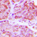 TTF1 / Txn Termination Factor Antibody - Immunohistochemical analysis of TTF1 staining in human breast cancer formalin fixed paraffin embedded tissue section. The section was pre-treated using heat mediated antigen retrieval with sodium citrate buffer (pH 6.0). The section was then incubated with the antibody at room temperature and detected using an HRP-conjugated compact polymer system. DAB was used as the chromogen. The section was then counterstained with hematoxylin and mounted with DPX.