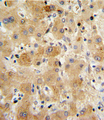 TTR / Transthyretin Antibody - Formalin-fixed and paraffin-embedded human hepatocarcinoma with TTR Antibody , which was peroxidase-conjugated to the secondary antibody, followed by DAB staining. This data demonstrates the use of this antibody for immunohistochemistry; clinical relevance has not been evaluated.