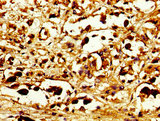 TUBD1 / Tubulin Delta Antibody - Immunohistochemistry image of paraffin-embedded human melanoma cancer at a dilution of 1:100