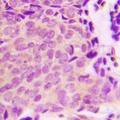 Tuberin / TSC2 Antibody - Immunohistochemical analysis of TSC2 (pS939) staining in human breast cancer formalin fixed paraffin embedded tissue section. The section was pre-treated using heat mediated antigen retrieval with sodium citrate buffer (pH 6.0). The section was then incubated with the antibody at room temperature and detected using an HRP-conjugated compact polymer system. DAB was used as the chromogen. The section was then counterstained with hematoxylin and mounted with DPX.