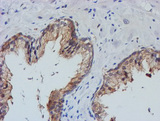 TULP3 Antibody - IHC of paraffin-embedded Carcinoma of Human prostate tissue using anti-TULP3 mouse monoclonal antibody.