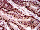 TWIST1 / TWIST Antibody - IHC of paraffin-embedded colon cancer tissues using TWIST1 mouse monoclonal antibody with DAB staining.