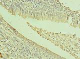 TXNDC11 Antibody - Immunohistochemistry of paraffin-embedded human lung cancer using antibody at dilution of 1:100.