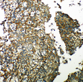 TXNRD2 Antibody - TXNRD2 antibody. IHC(P): Human Lung Cancer Tissue.