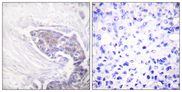 TXNRD2 Antibody - Immunohistochemistry analysis of paraffin-embedded human breast carcinoma tissue, using TRXR2 Antibody. The picture on the right is blocked with the synthesized peptide.